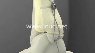 Medial Malleolus ORIF  ICUC® Video [upl. by Fina70]