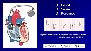 Pacemaker Modes and Settings [upl. by Enyt269]