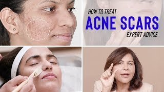 Treatments for ACNE SCARS  Dr Bindus Expert Advice [upl. by Aidnama]