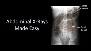 Abdominal XRays Made Easy [upl. by Ellegna670]