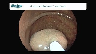 Endoscopic Polypectomy with Eleview™ [upl. by Eiuqnimod]