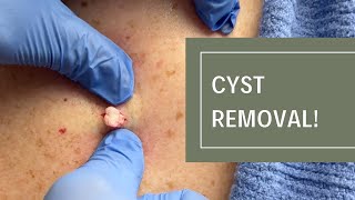 Cyst Removal  Dr Derm [upl. by Aloz]