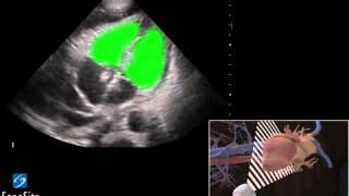 3D Lehrvideo Ultraschallgestützte Paricardiocentesis Anwendung  SonoSite Ultraschall [upl. by Nyleahs]