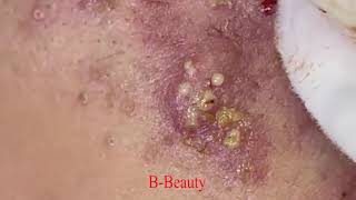 Pimple Removal and Acnes Treatment  BBeauty 07 [upl. by Wira]