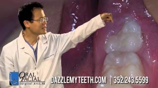 wisdom teeth pain orlando [upl. by Neiviv]