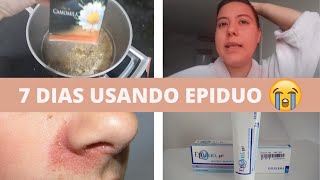 7 DIAS USANDO EPIDUO GEL  doeu muito [upl. by Leamiba598]