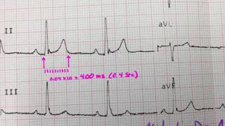 The Qt interval [upl. by Whitehurst]