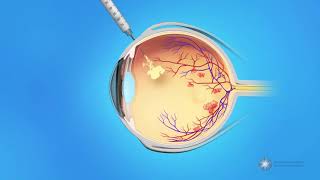 Mentice  Thoracic Endovascular Aortic Repair TEVAR Case Video [upl. by Radbourne]