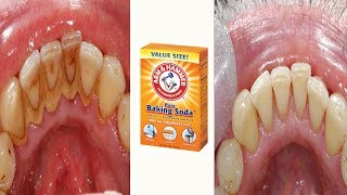 How to Remove Dental Plaque and Tartar at Home [upl. by Nylac]