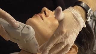 HIFU Facial  Demostración Ultralift HIFU  Cosmobeauty2017 [upl. by Jasmine251]