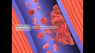 Atherectomy for Peripheral Arterial Occlusive Disease  Part 2 [upl. by Divadnhoj367]