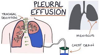 Understanding Pleural Effusions [upl. by Irahs479]