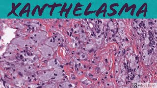 Xanthelasma Xanthoma of Eyelid 5Minute Pathology Pearls [upl. by Richards149]