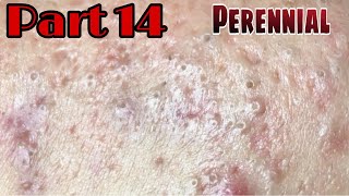 Thoroughly remove all of them  PART 14  BYoung Spa Quyet Hair [upl. by Ruenhcs779]