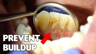 Ultrasonic teeth cleaning watch why your gums bleed [upl. by Seiter]