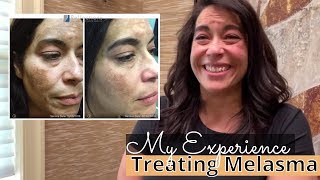 Melasma Treatment with Tranexamic Acid  My Experience  TreatmentResistant Melasma [upl. by Glynas]