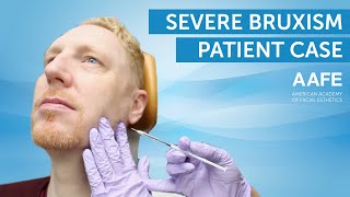 Treating Bruxism with Botox  AAFE [upl. by Rigby]