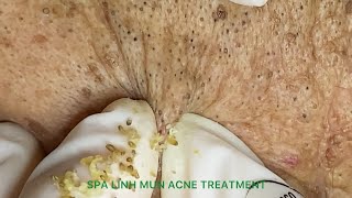 Acne treatment for 90yearold gentlemen part 1  Acne treatment under the skin 013 [upl. by Verlee360]