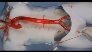 REBOA Resuscitative Endovascular Balloon Occlusion of the Aorta [upl. by Ynagoham104]