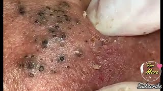 Dr Pop  Deep Blackheads in old Skin removing amp treatment 2020 Part 6 [upl. by Immat]