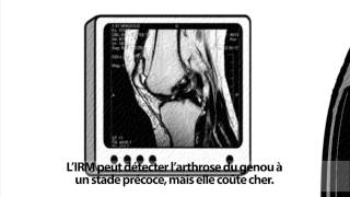 Larthrose est une maladie qui se soigne [upl. by Elliot]