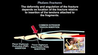 Phalanx Fractures  Everything You Need To Know  Dr Nabil Ebraheim [upl. by Handler]