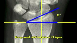 Distal Radius Radiographic Parameters [upl. by Eelyab]