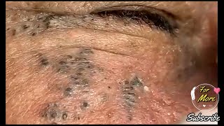 Dr Pop  Deep Blackheads in old Skin removing amp treatment 2020 Part 5 [upl. by Akeemaj]