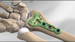 Distal Radius Fracture Repair  Volar Plate [upl. by Ashti]