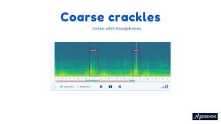 Lung sounds  coarse crackles [upl. by Arreic424]