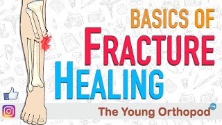 Fracture Healing  ANIMATION  BASICS  The Young Orthopod [upl. by Eisenstark]