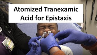 Atomized Tranexamic Acid for Epistaxis Control [upl. by Theodore]