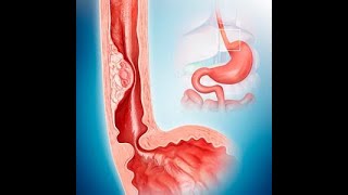 Esophagus Disorders  Causes Symptoms Treatments amp More… [upl. by Seadon958]