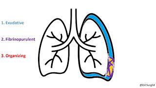 Empyema and Pleural Effusions [upl. by Atyekram]