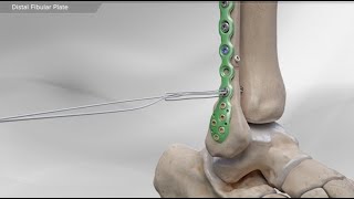 Distal Fibular Plate [upl. by Anairda]