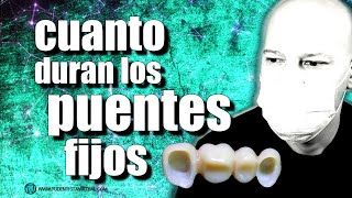 🔵PROBLEMAS con los PUENTES FIJOS sin IMPLANTES [upl. by Yalc]