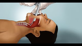 Pediatric Endotracheal Intubation by J Nagler et al  OPENPediatrics [upl. by Eydnarb]