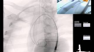 ETT Cuff Pressure CheckAssessment [upl. by Airbas]