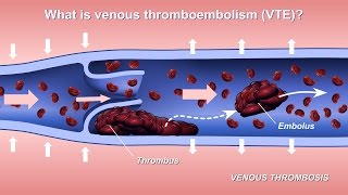 Formation of Deep Vein Thrombosis [upl. by Enelahs]