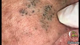 Dr Pop  Deep Blackheads in old Skin removing amp treatment 2020 Part 4 HD [upl. by Kev]