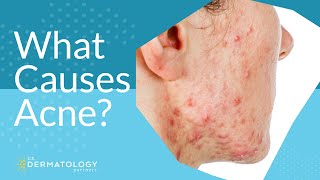 What Causes Acne  Explained by Dermatologist [upl. by Ueihtam482]