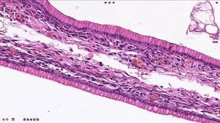 Ovary Mucinous cystadenocarcinoma [upl. by Alison315]