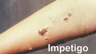 Impetigo [upl. by Teirtza]