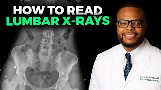 How to Read a Lumbar XRay [upl. by Arlina]