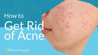 Acne Treatment  Explained by Dermatologist [upl. by Yekim907]