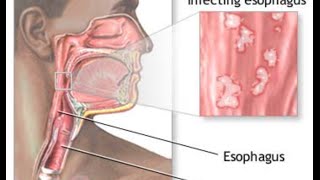 Candida Esophagitis [upl. by Anilecram]