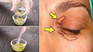 Xanthelasma removal at home  Home remedy to get rid of cholesterol deposits around your eyes natura [upl. by Roy749]