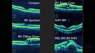 Macular OCT Interpretation A Practical Discussion with Dr David E Lederer [upl. by Oates]