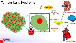 Tumour Lysis Syndrome [upl. by Rutan]