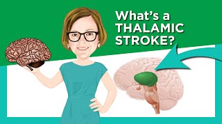 Thalamic Stroke [upl. by Inman]